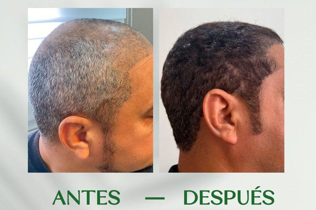 6 Meses de avance en trasplante capilar