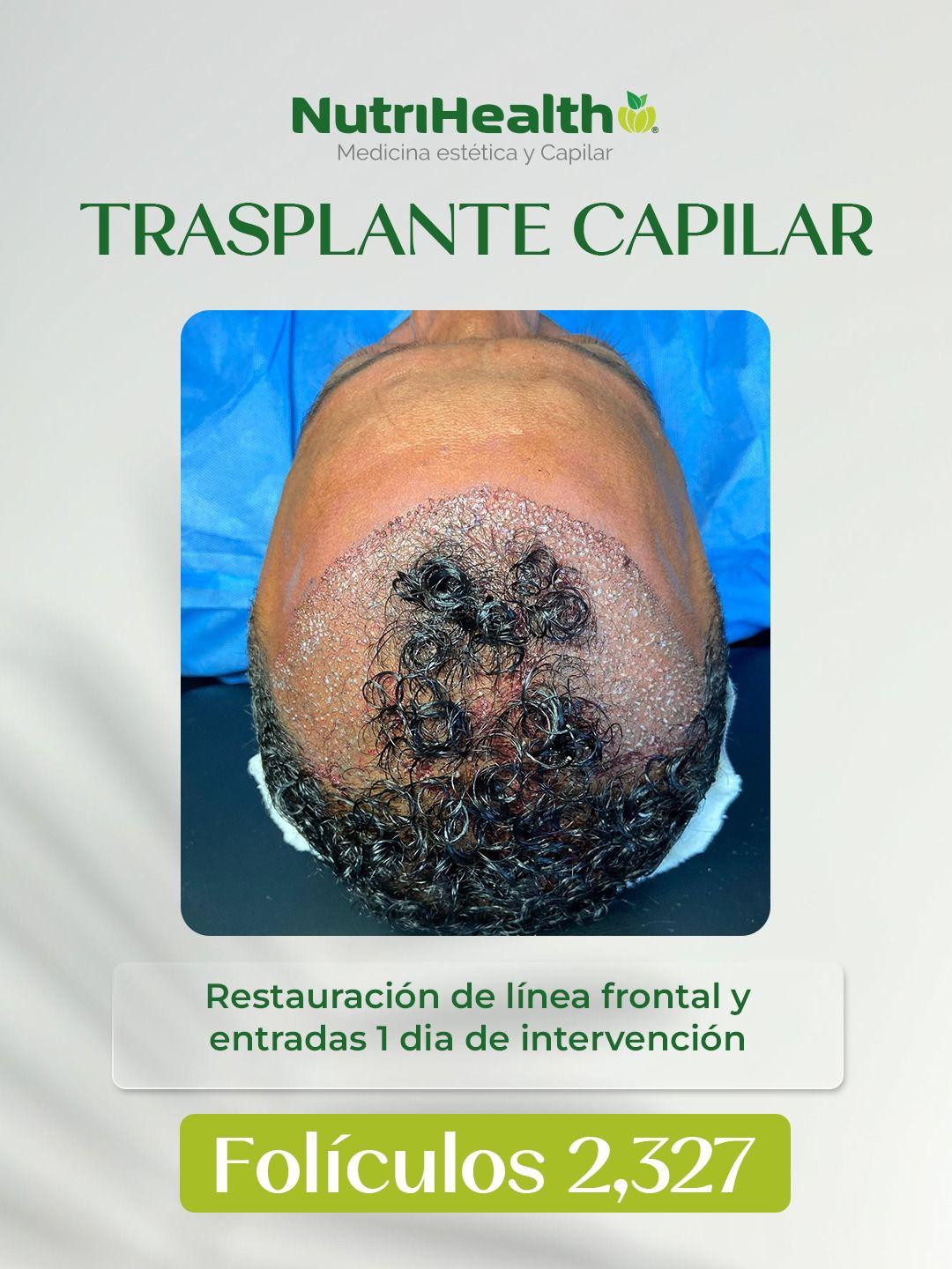 Restauración de línea frontal