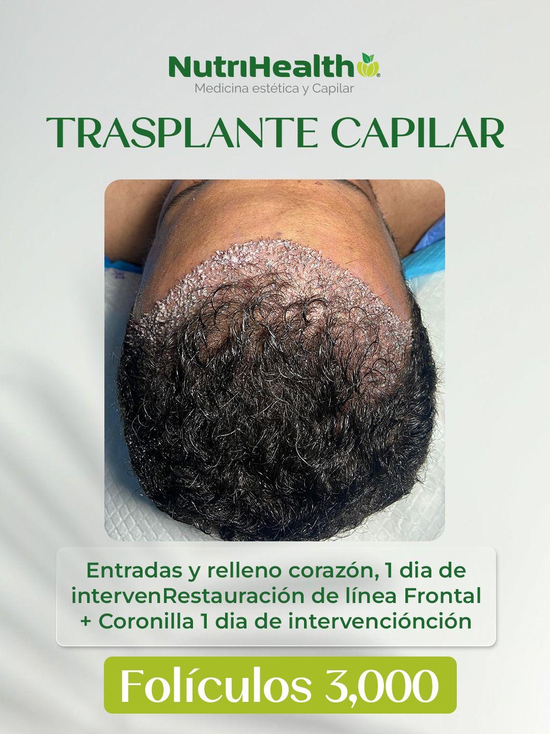 Entrada y relleno de la línea frontal