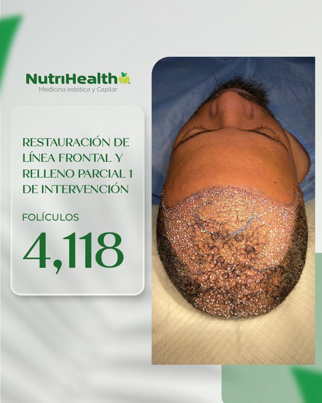 RELLENO PARCIAL FOLÍCULOS 4,118