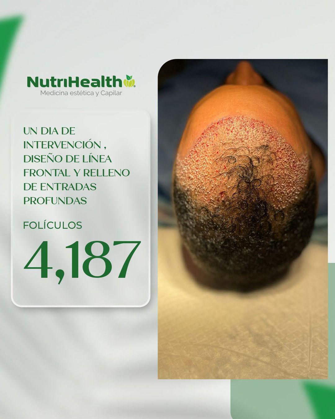 Un caso real de trasplante capilar con resultados naturales