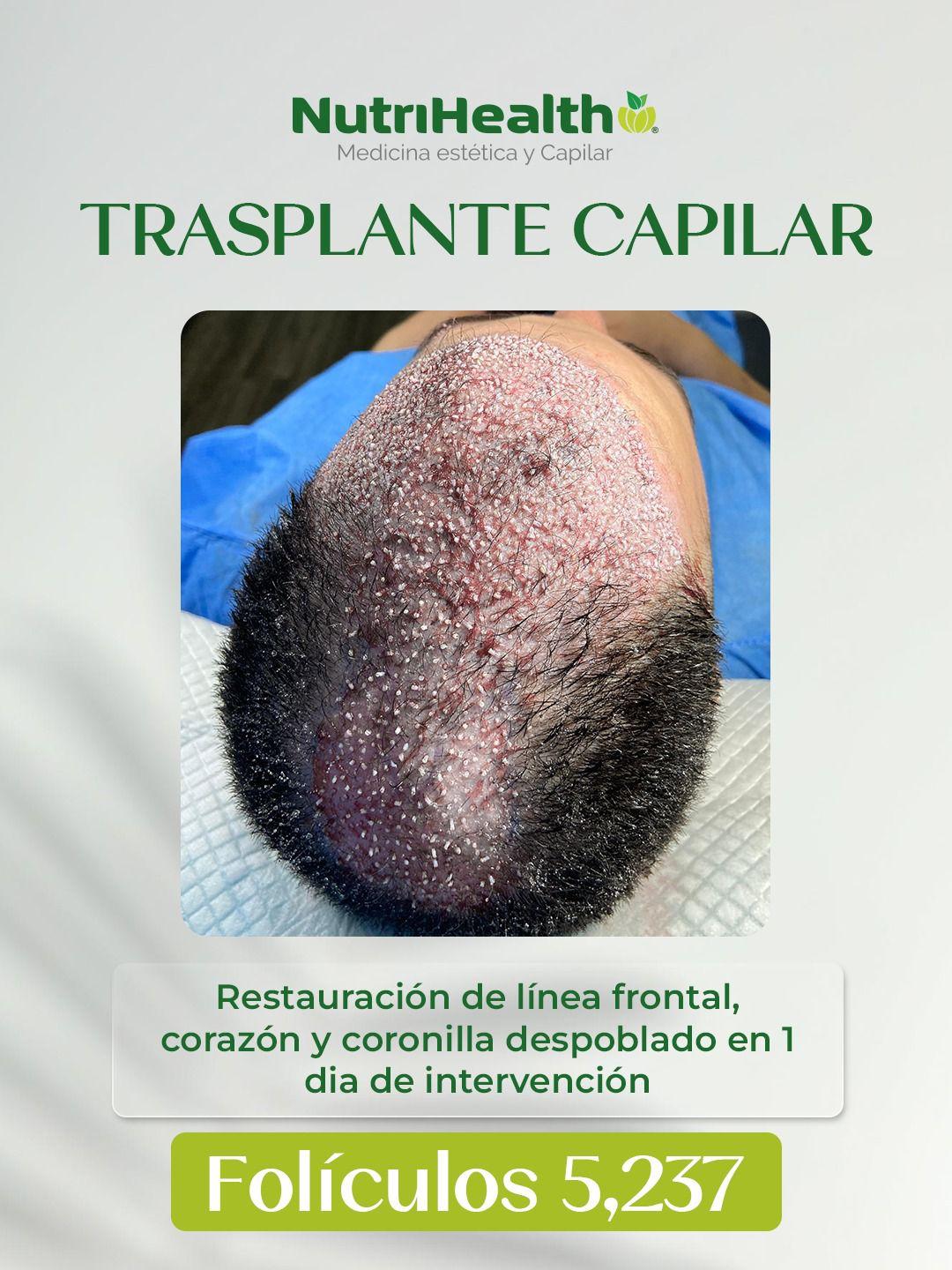 Restauración de línea frontal