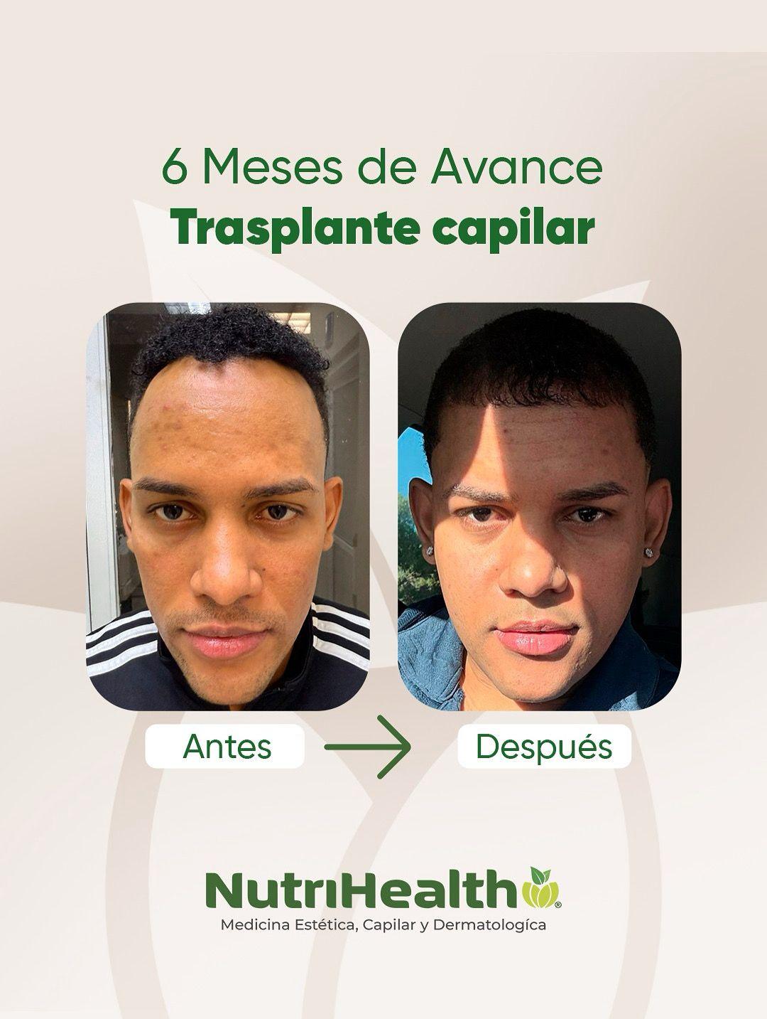 Resultado trasplante capilar antes y después