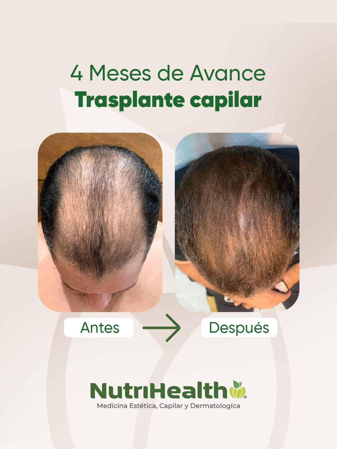 Resultado trasplante capilar antes y después